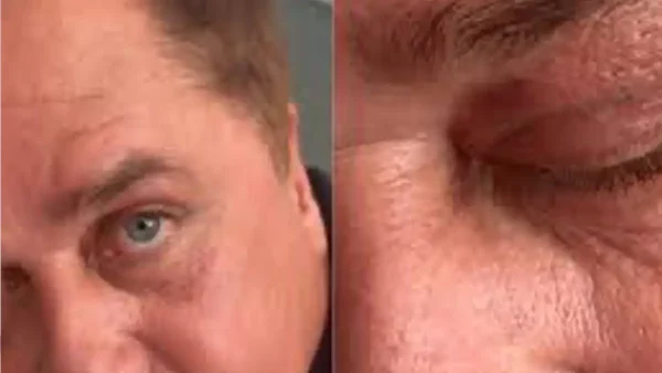 Antes e Depois: veja como ficou Leonardo após blefaroplastia